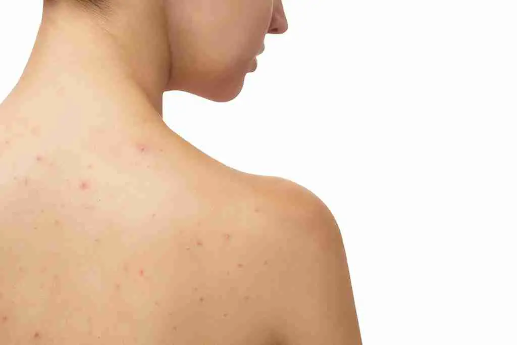 Cause of Shoulder Acne