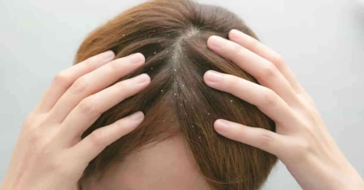 what are the essential oils for dandruff